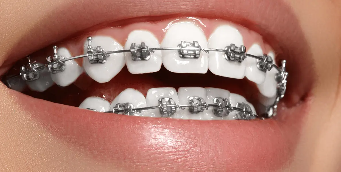 Orthodontic-Brackets